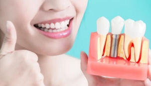 Kayıp dişleriniz için implant tedavisi tercih edin