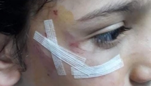 Sokak köpeği 8 yaşındaki Mehmet'in yanağını koparıyordu