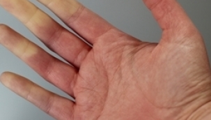 Sigara ve kafeinli içecekler raynaud fenomonini tetikliyor