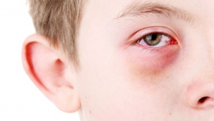 Kış mevsiminde kuru göz hastalığına dikkat