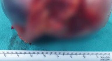 Böbreğinden 9 santimetre çapında kitle çıktı