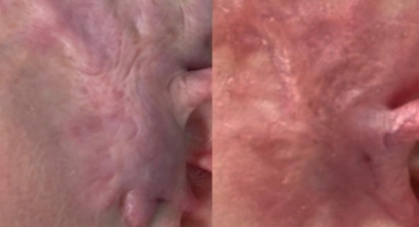 Yanık izlerine lazer tedavisi ile çözüm bulunuyor