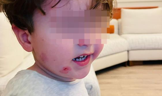 Kreşe bıraktığı çocuğunu darp edilmiş halde aldı